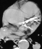 Noncontrast Helical Ct