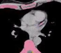 Coronary artery calcification - CT. Image obtained