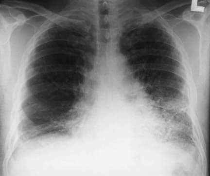Asbestosis. Posteroanterior chest radiograph in a.