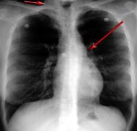 Radiografia de tórax póstero-anterior demonstra uma p. ..