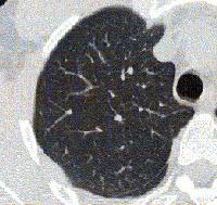 Asthma. High-resolution CT scan of the thorax obta