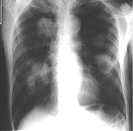 prostate cancer lung metastasis