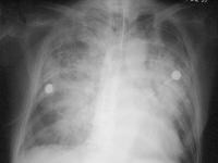 alveolar pulmonary edema