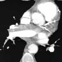 Computed tomography angiogram in a 69-year-old man