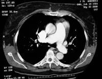 Ctpa Scan