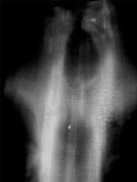 A tomografia linear demonstra estenoses traqueais ...