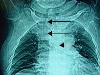 A radiografia de tórax mostra um Bócio intratorácico ...
