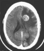 Contrast-enhanced CT scan shows 2 enhancing cerebr