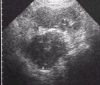 Sonogram shows a 6-cm right adrenal metastasis of 