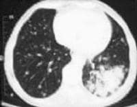 Pulmonary metastases from a primary bronchial neop