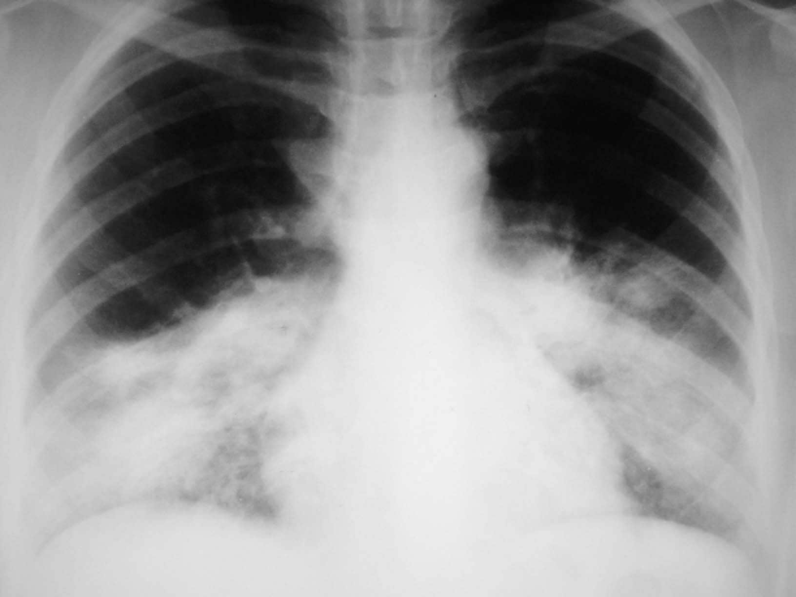 Легионеллезная пневмония рентген