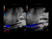 Abdominal Distention Causes