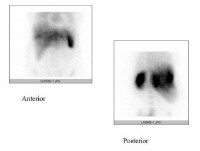 Budd-Chiari Syndrome Imaging Budd-Chiari Syndrome Imaging