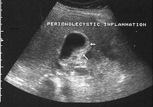 normal gallbladder ultrasound images. +gallbladder+ultrasound