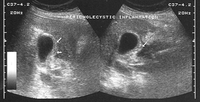 gallbladder ultrasound pics. Ultrasound image of the