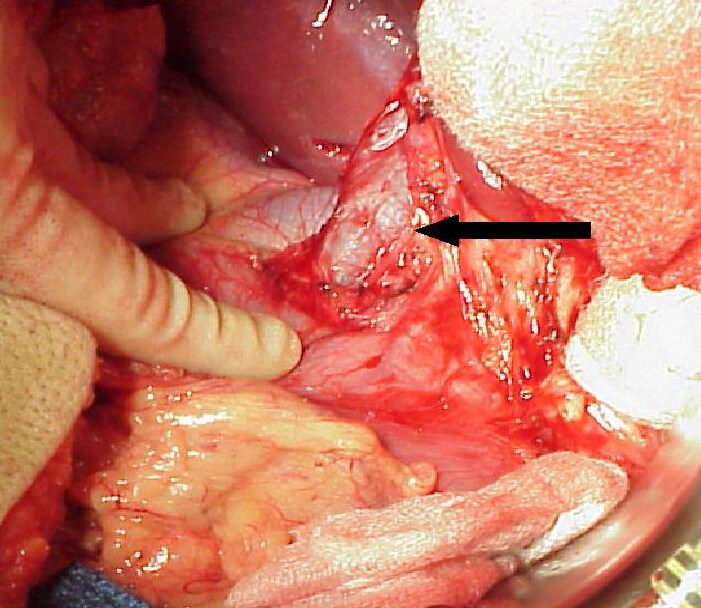 Recurring Cystic Hygroma. finger recurrent margins