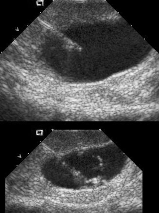 gallbladder ultrasound. acalculous; gallbladder