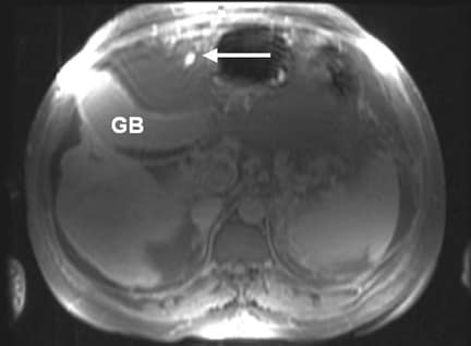 porcelain gallbladder ultrasound. of Gallbladder+location+