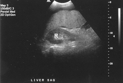 Advanced cirrhosis. A nodular liver, echogenic in comparison to renal 