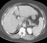 A patent, collateral paraumbilical vein (arrow) ar