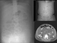 A 51-year-old male who has cirrhosis with massive 