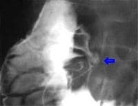 Vista lateral de um anterior i. úlcera duodenal parede ..
