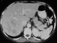 Hepatic Adenoma Imaging Hepatic Adenoma Imaging
