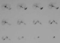 Hepatic Adenoma Imaging Hepatic Adenoma Imaging