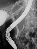 Pancreas Divisum Imaging: Overview, Radiography, Computed Tomography