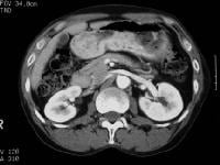 Pancreas Divisum Imaging: Overview, Radiography, Computed Tomography