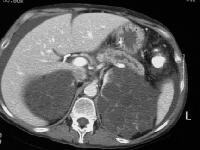 Pancreas Divisum Imaging: Overview, Radiography, Computed Tomography