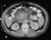 Acute pancreatitis. Focal pancreatitis involving p