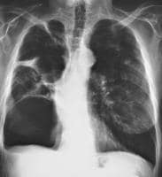 Pneumoperitoneum X Ray