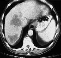 Hepatic Lymphoma Ct