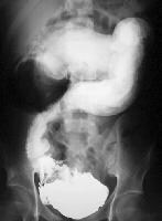 Gastrointestinal Tuberculosis Imaging Gastrointestinal Tuberculosis Imaging