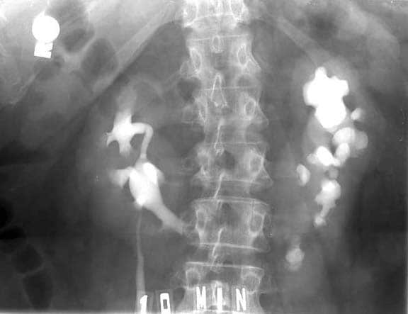 Intravenous urogram (IVU) demonstrates horseshoe kidney.