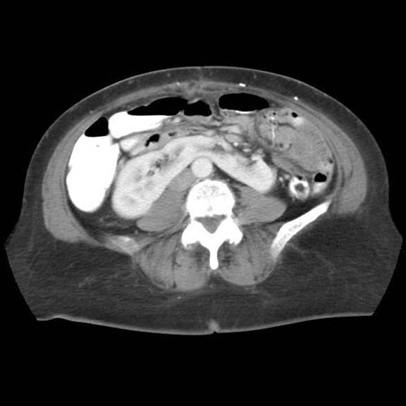 Axial computed tomography (CT) scan obtained through the abdomen after the 