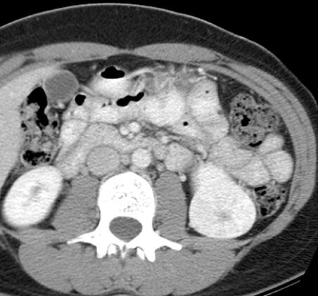 Contrast-enhanced computed tomography (CT) scan of the abdomen obtained 