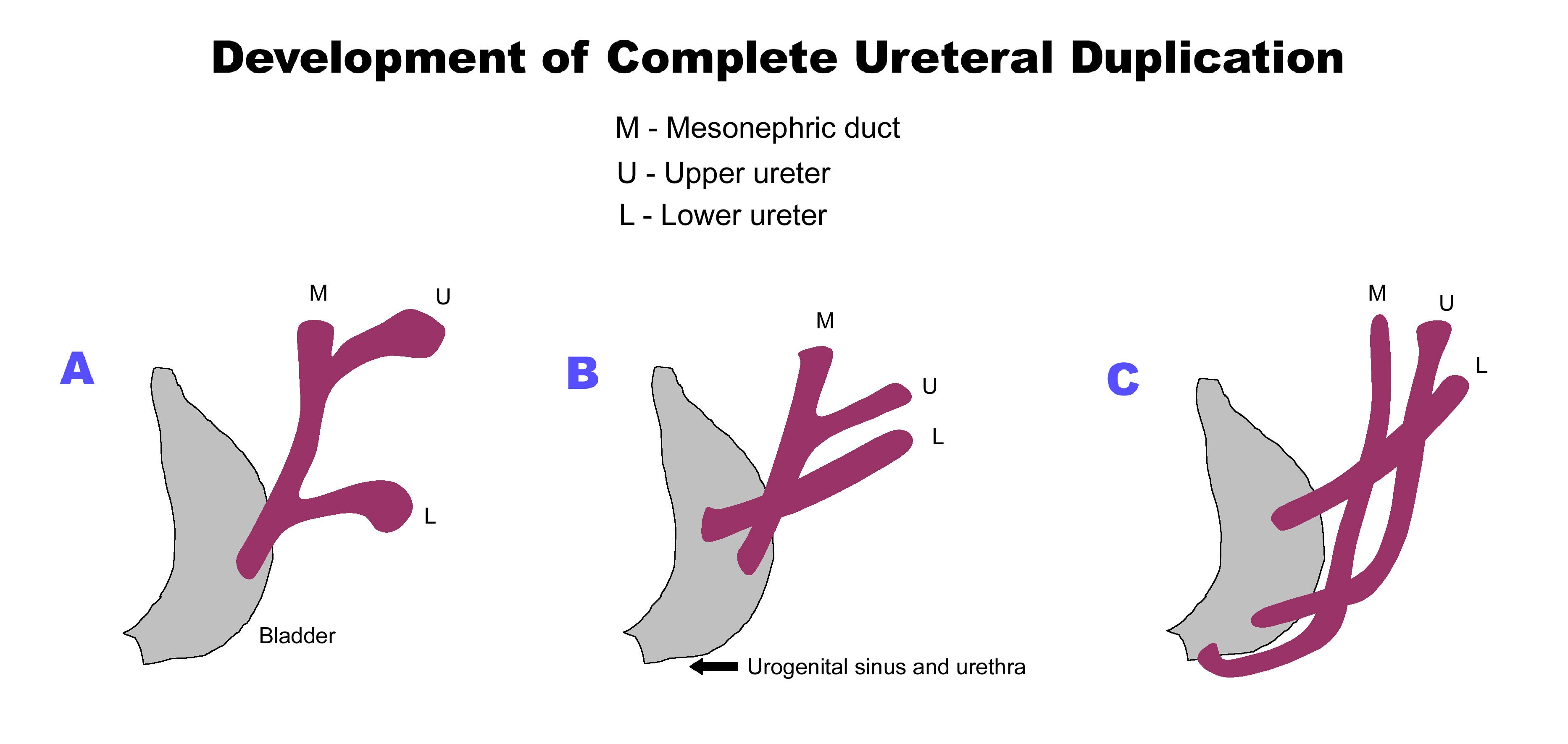 Line Diagram Shows Development Of Complete Ureteral Duplication line-diagram-shows-development-of-complete-ureteral-duplication