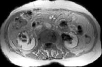 extrarenal pelvis ct