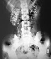 Calcified Kidney