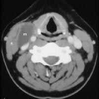 cleft branchial cyst