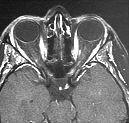 A 35-year-old woman with acute onset of left eye pain and vision decline.