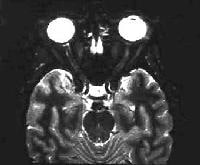 A 43-year-old woman with acute vision loss and eye