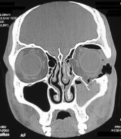 Orbital Fractures; Blow-Out Fractures; Fractures, Blow-Out