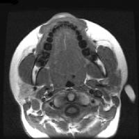 Parotid Masses