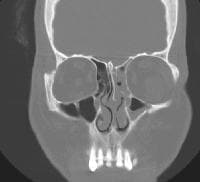 Espessamento da mucosa da a. etmoidal anterior esquerda ..