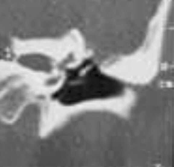 herniation of brain. herniation of rain tissue