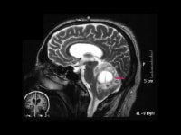 von Hippel-Lindau syndrome. Sagittal T2-weighted M