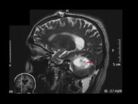 von Hippel-Lindau syndrome. Sagittal T2-weighted M